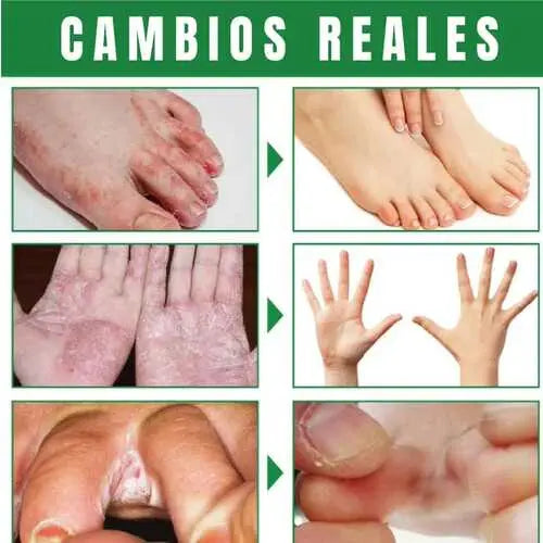 Deshazte del hongo en tus pies/Spray antifúngico de acción rápida